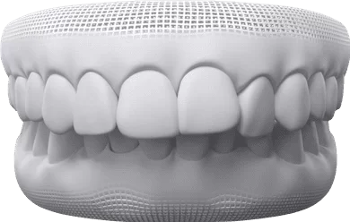 Overbite