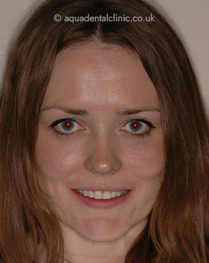 FullFace