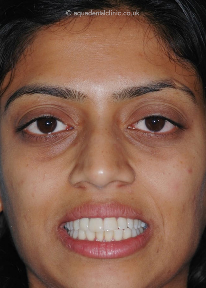 Full Face