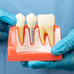 How Long Do Dental Implants Take? Timeline Guide | Pinner Dentist
