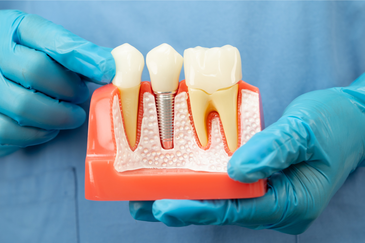 How Long Do Dental Implants Take? Timeline Guide | Pinner Dentist