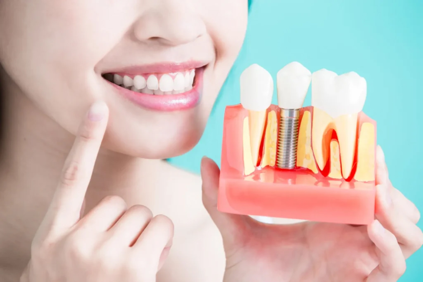 dental-implants-cost