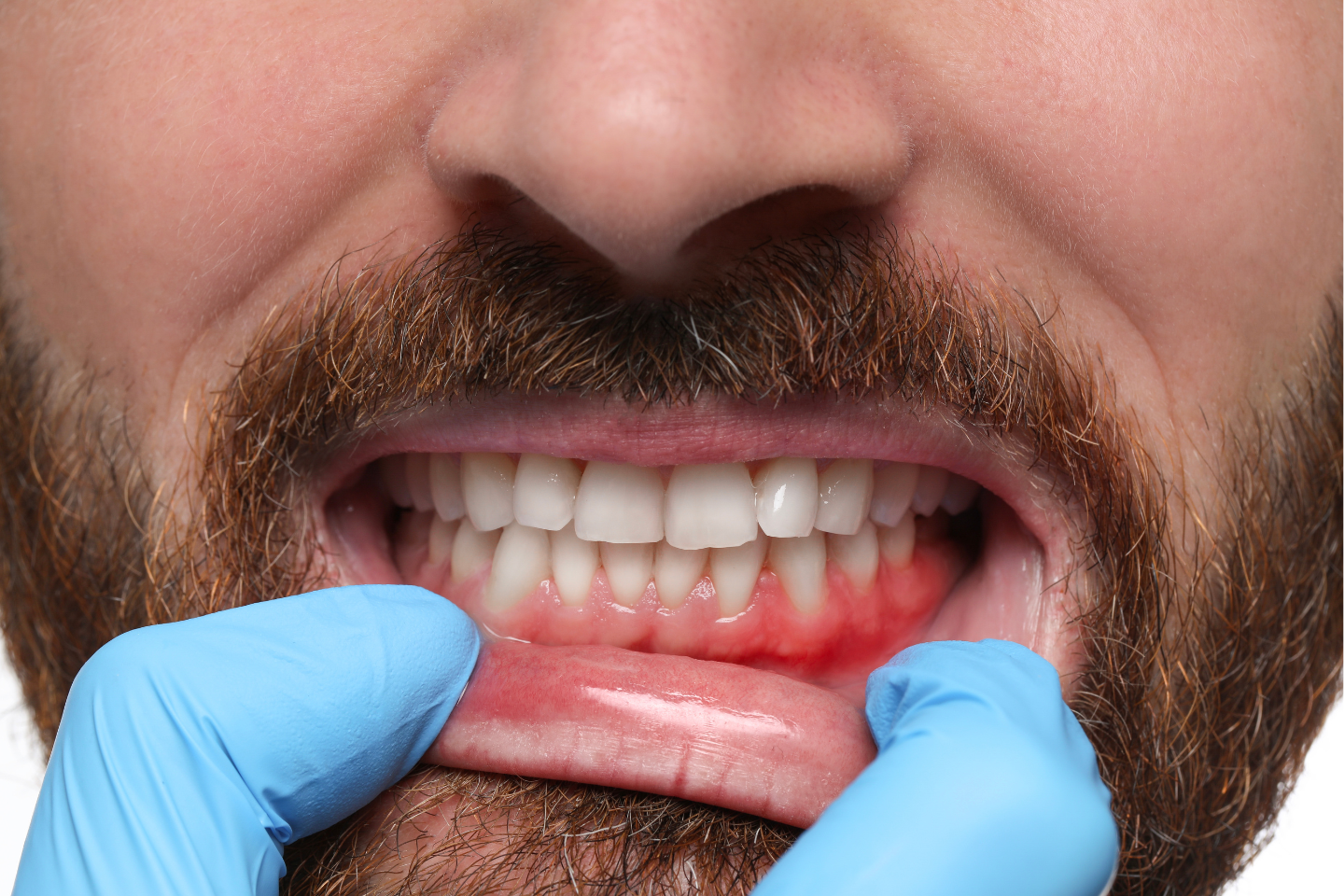 7 Early Signs of Gum Disease You Should Never Ignore | Aqua Dental Clinic