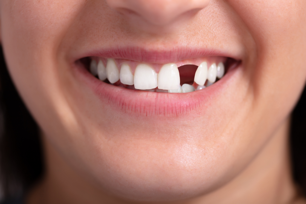 What Happens If You Delay Replacing a Missing Tooth? | Aqua Dental Clinic