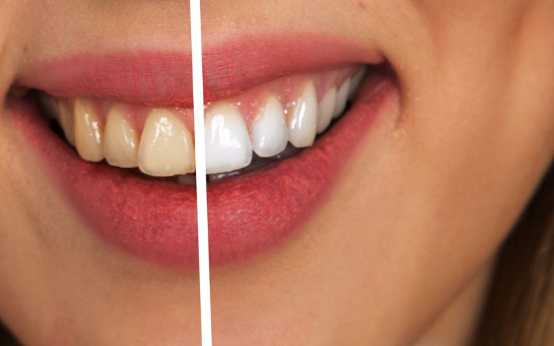 teeth whitening