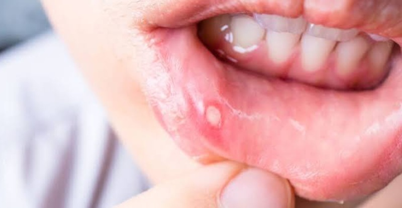 mouth ulcers