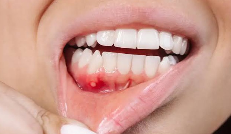 sore gums
