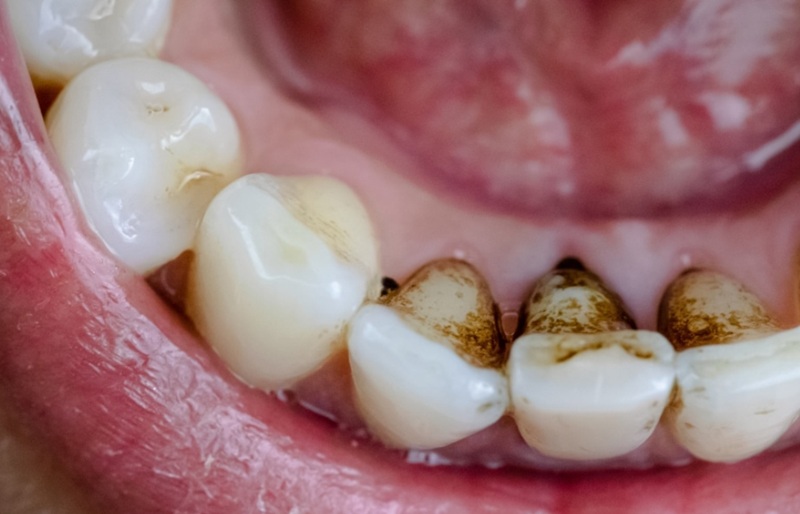 stains on teeth