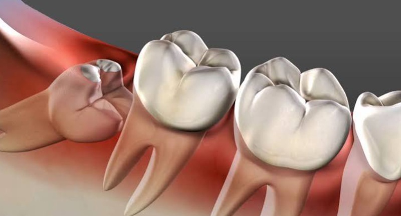 wisdom teeth issue image